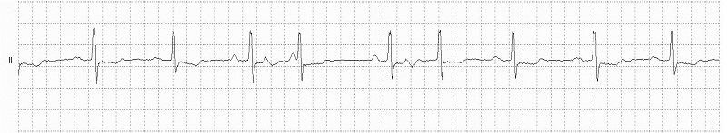 SVEB Patterns (Bigeminy) Rhythm Strip